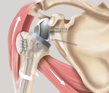 Schulterprothese